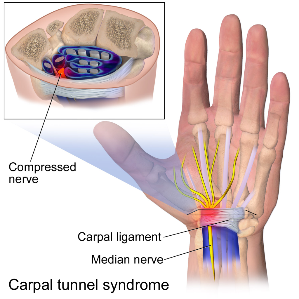 Carpal Tunnel in Clearwater, FL Dr. Russell Janssen